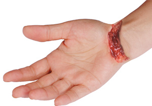 nerve damage hand  cut