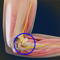 Elbow NSW | Elbow Joint Replacement, NSW | Radius & Ulna NSW